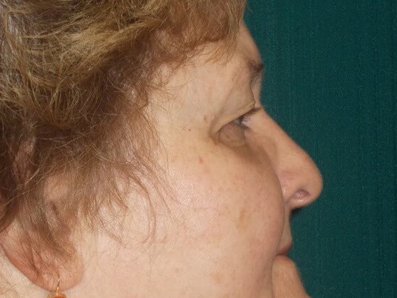 Side Before