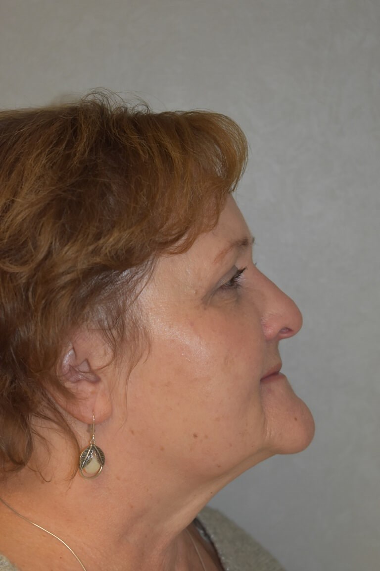 Side After
