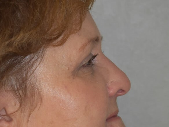 Side After