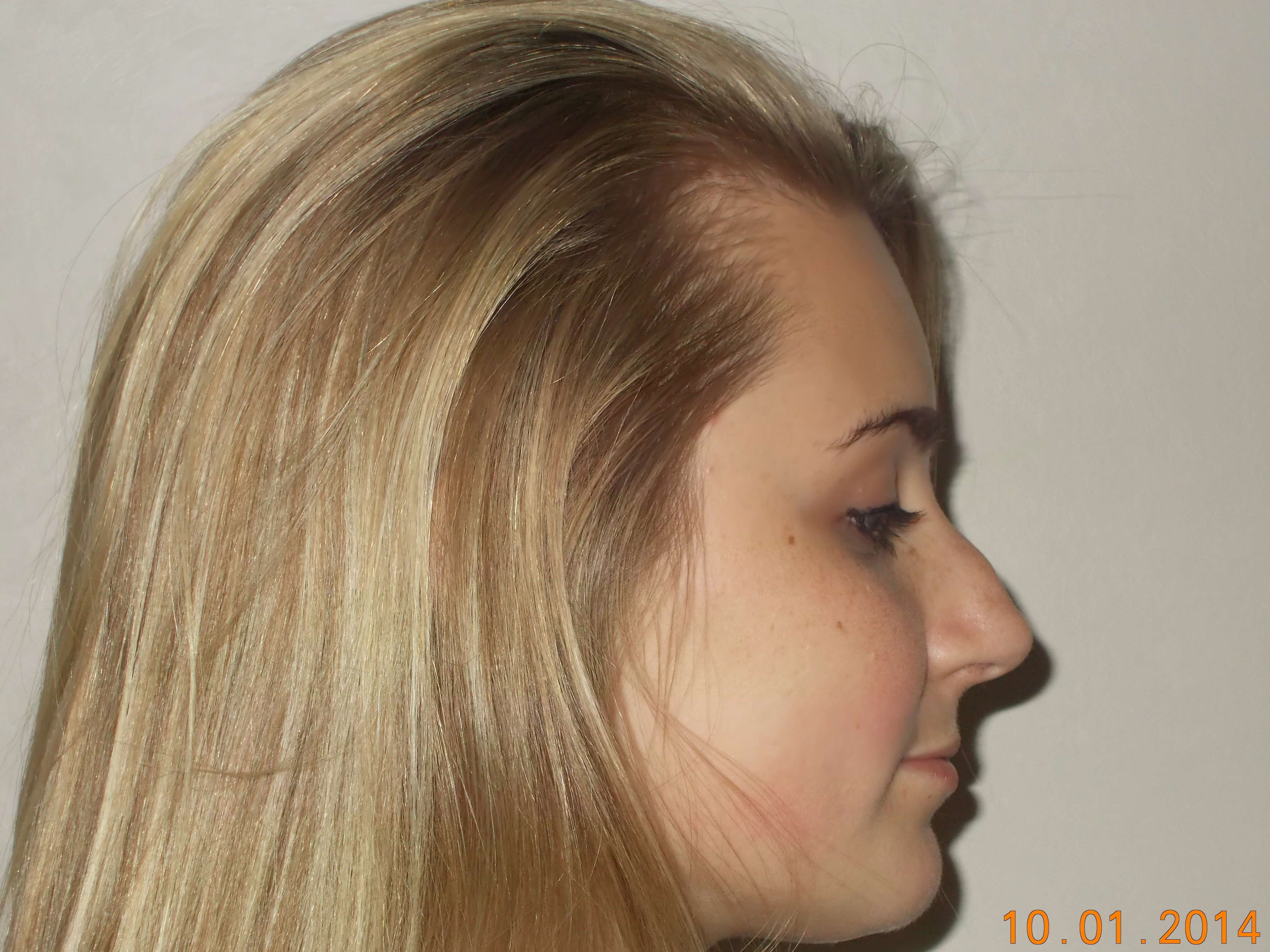 Side View Before