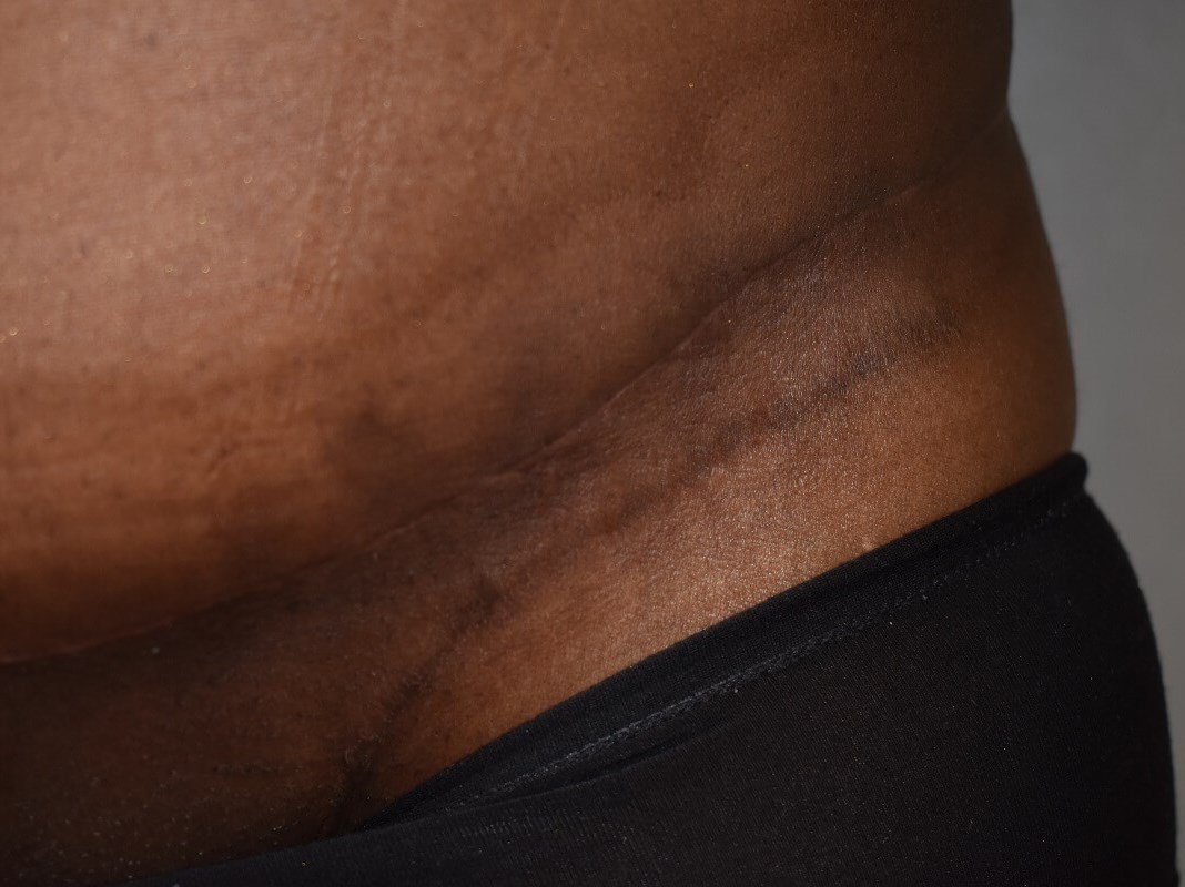 Thick Raised Scar (Keloid) After