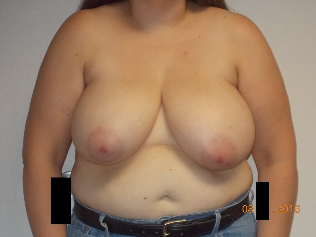 Front View Before