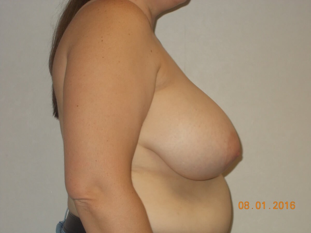 Side View Before