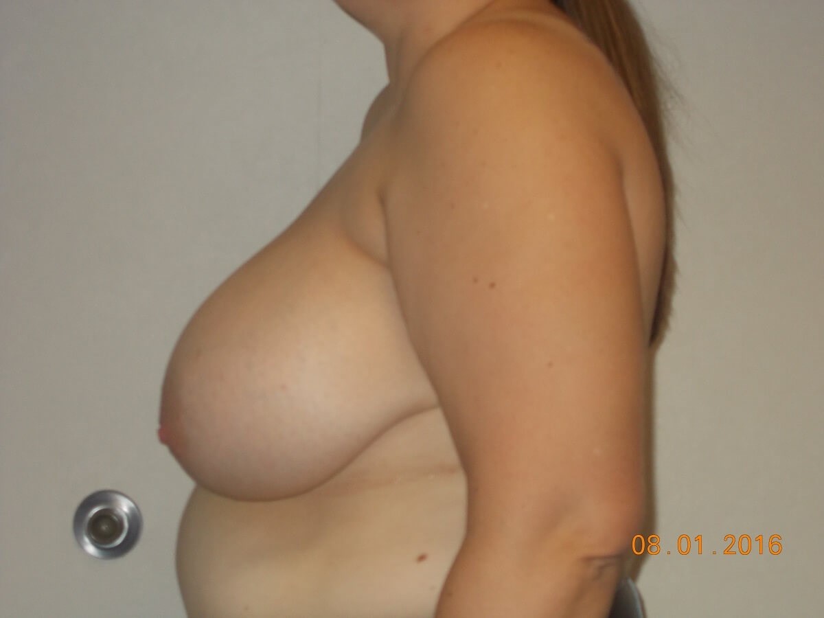 Side View Before