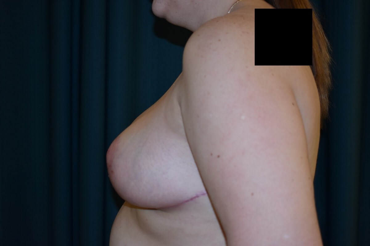 Side View After