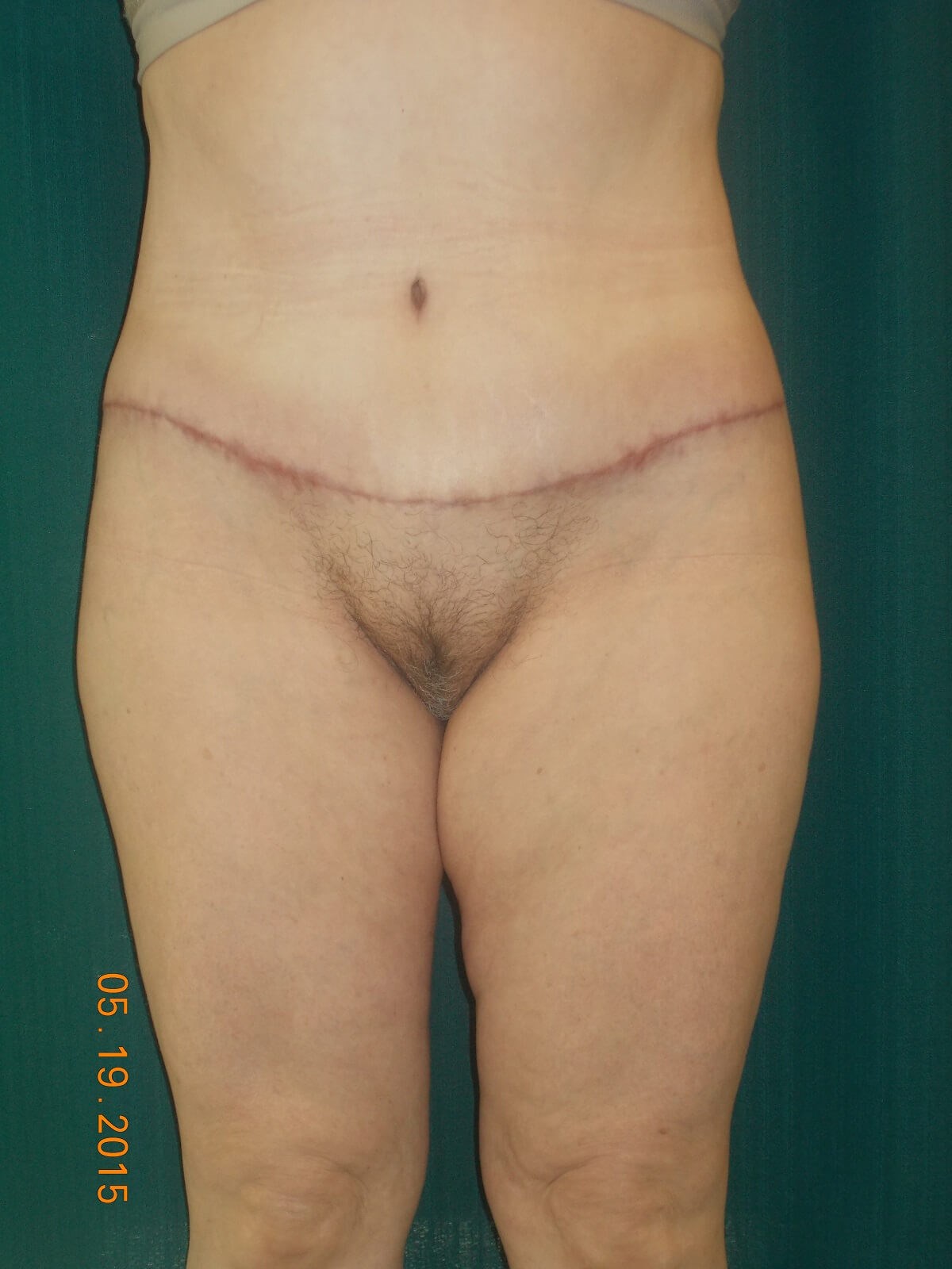 Before Image