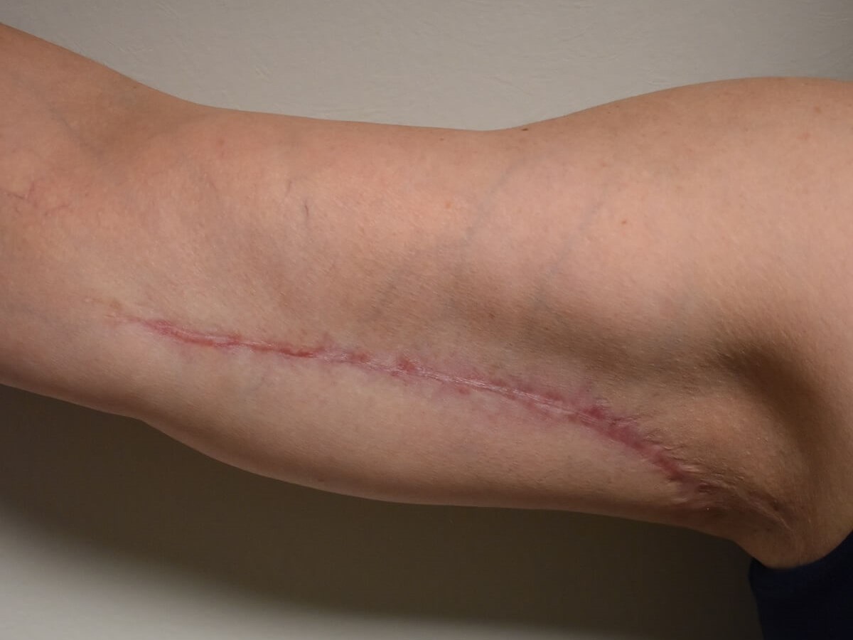 Right Arm After