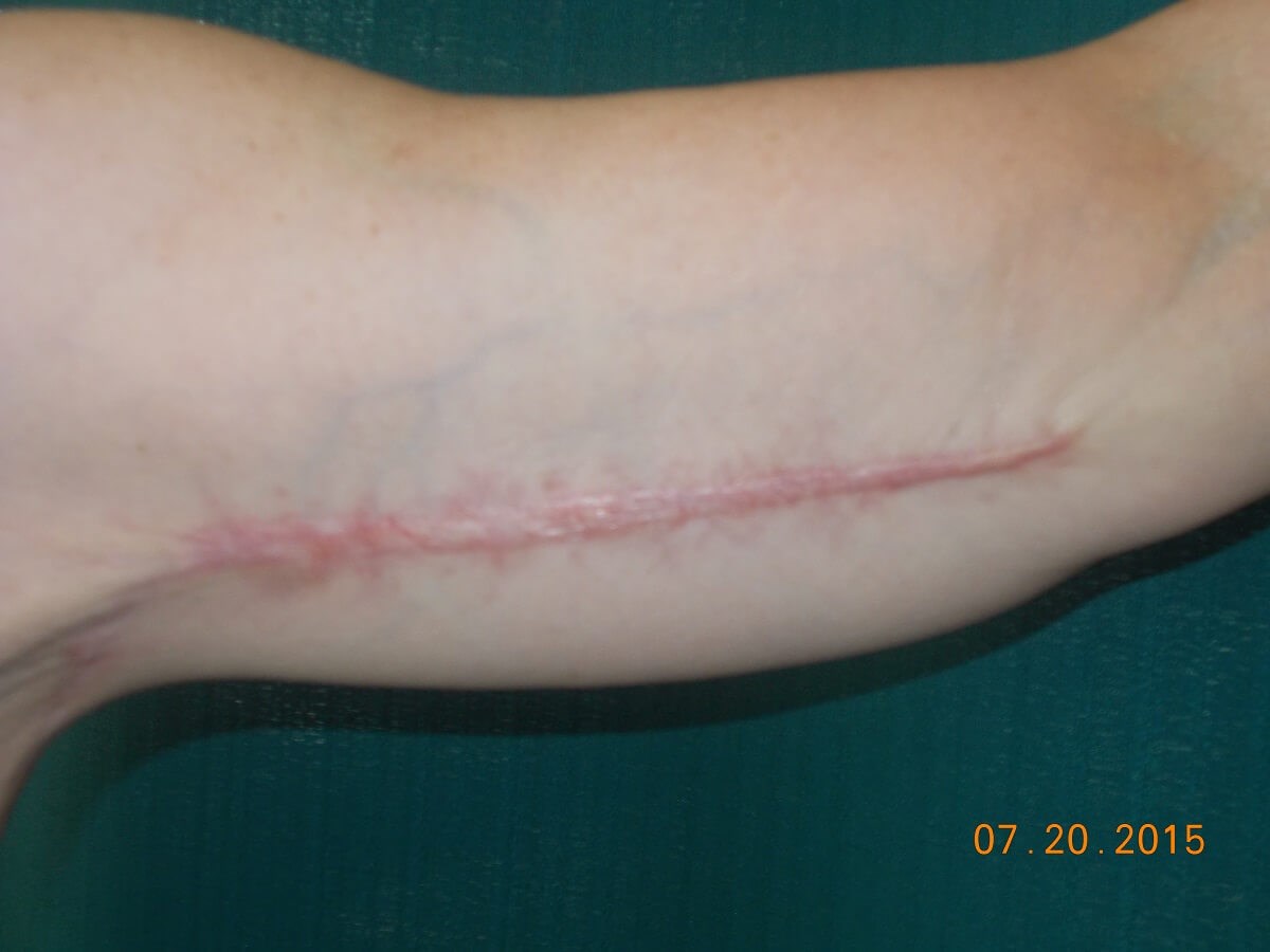 Left Arm Before