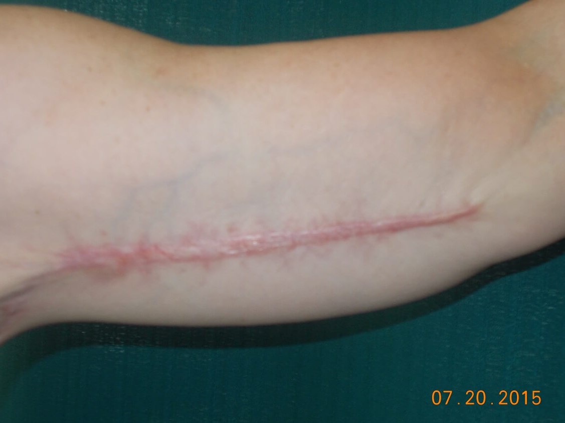 Left Arm Before