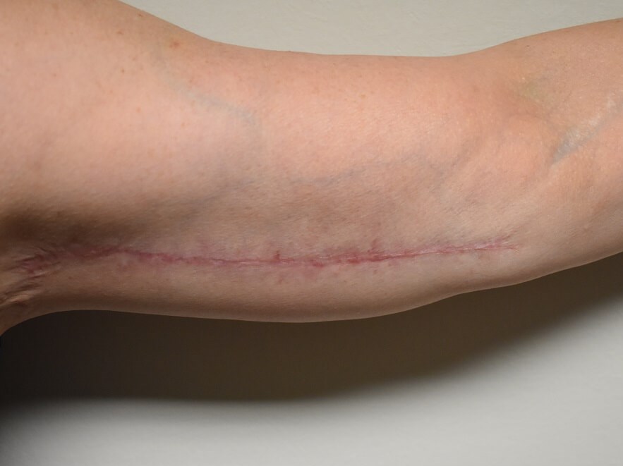 Left Arm After