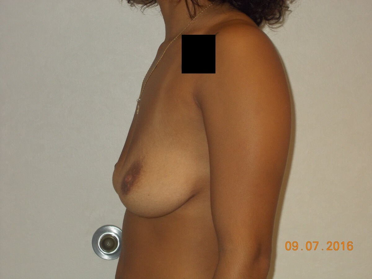 Side View Before