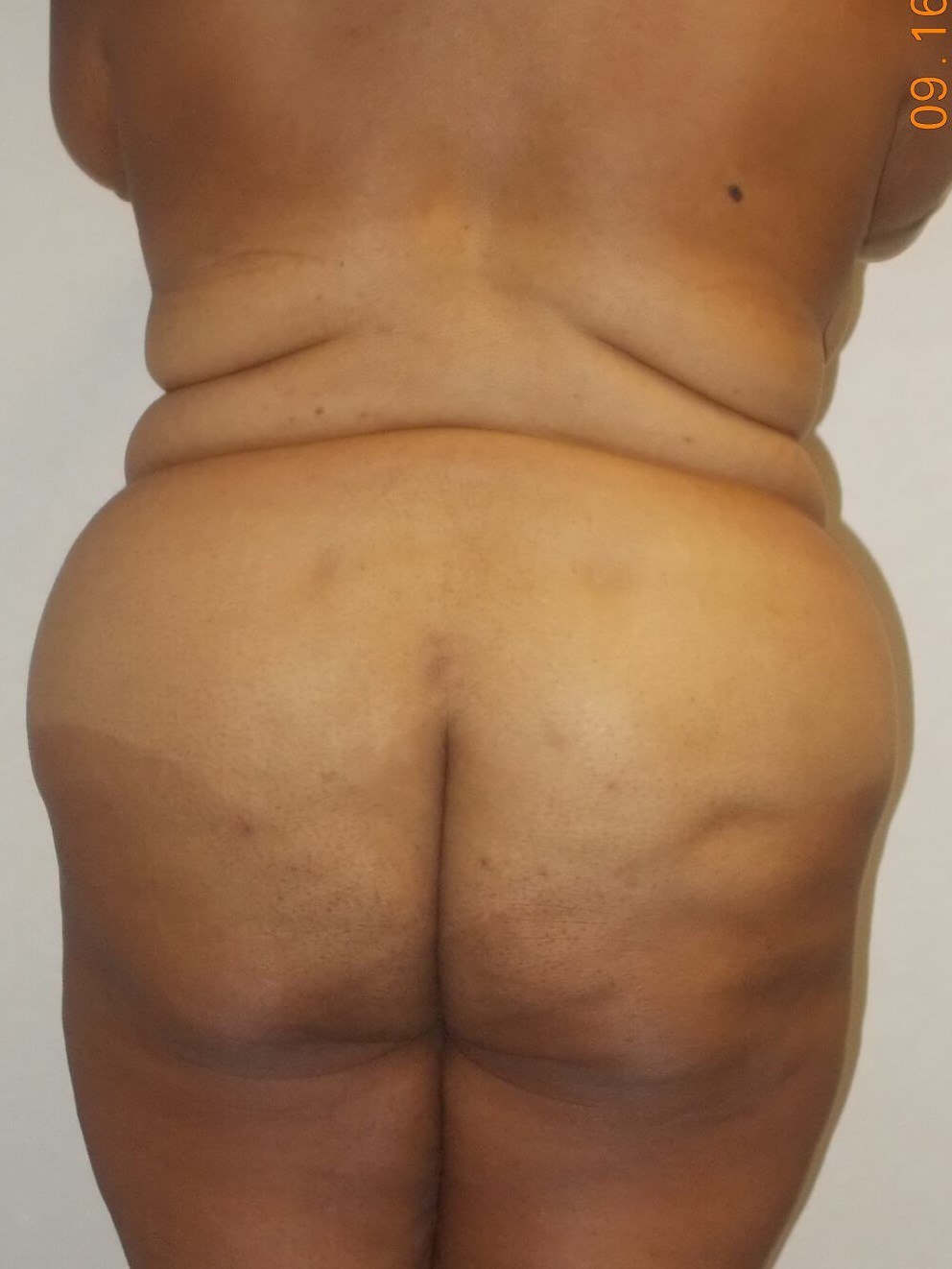 Back View Before