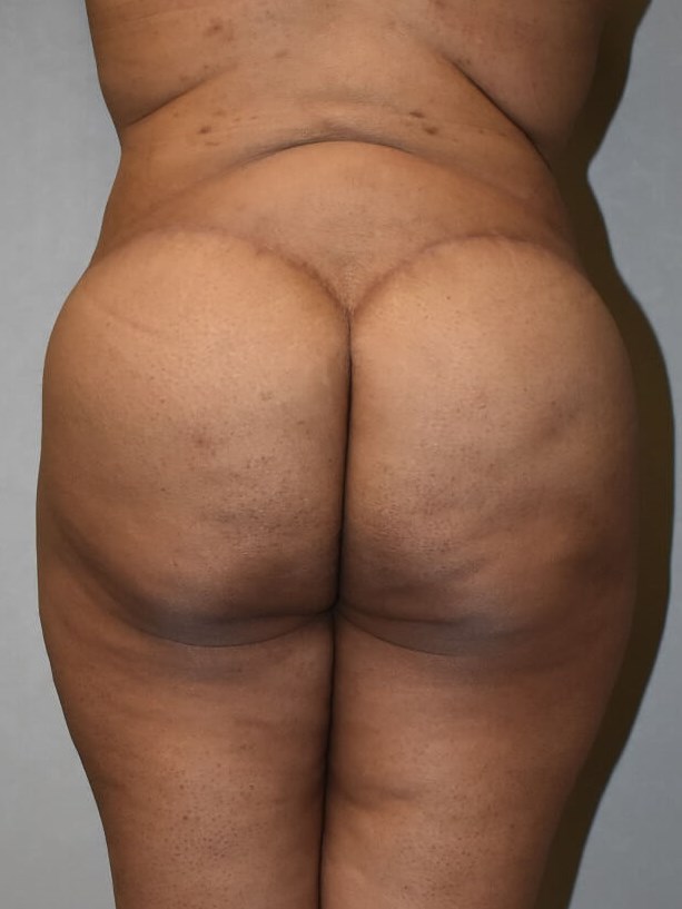 Back View After