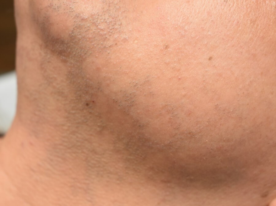 Front And Side View After 1 Treatment