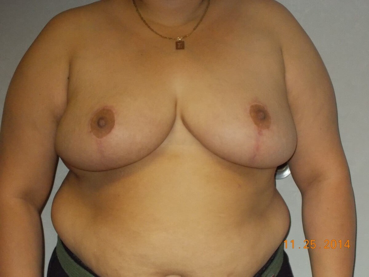 Front View After