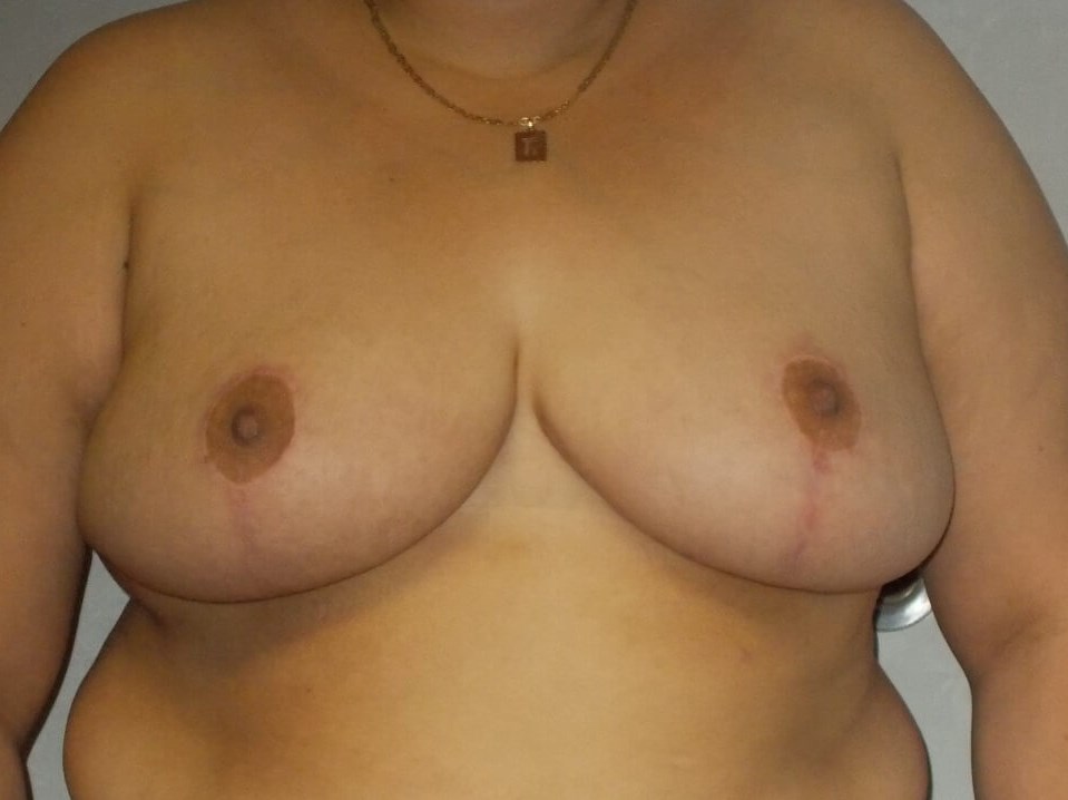 Front View After