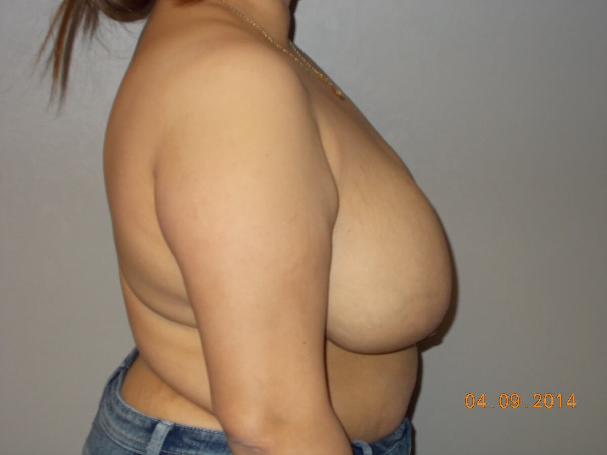 Side View Before