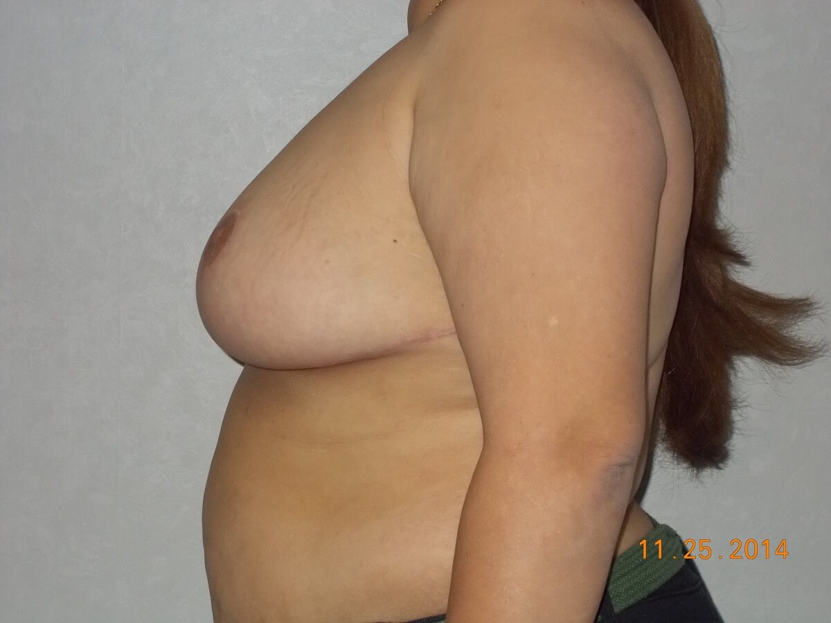 Side View After
