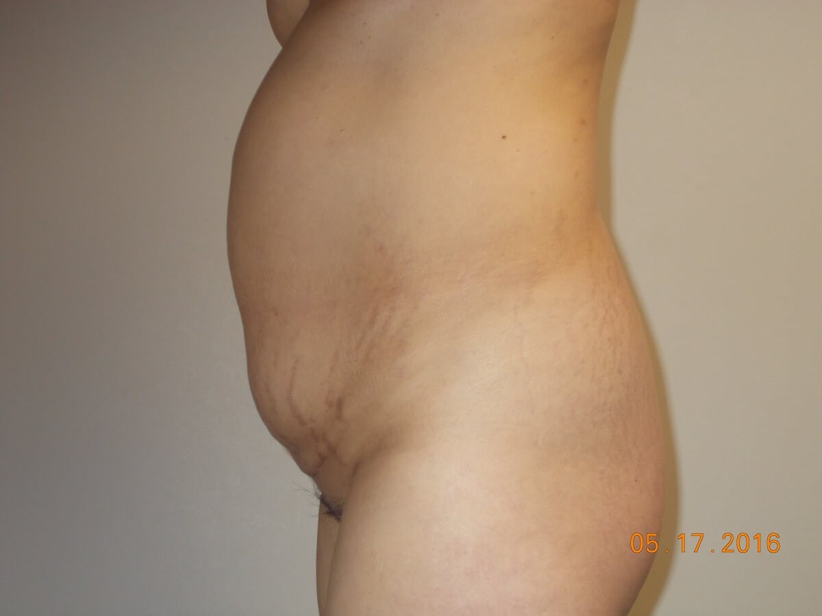 Side View Before