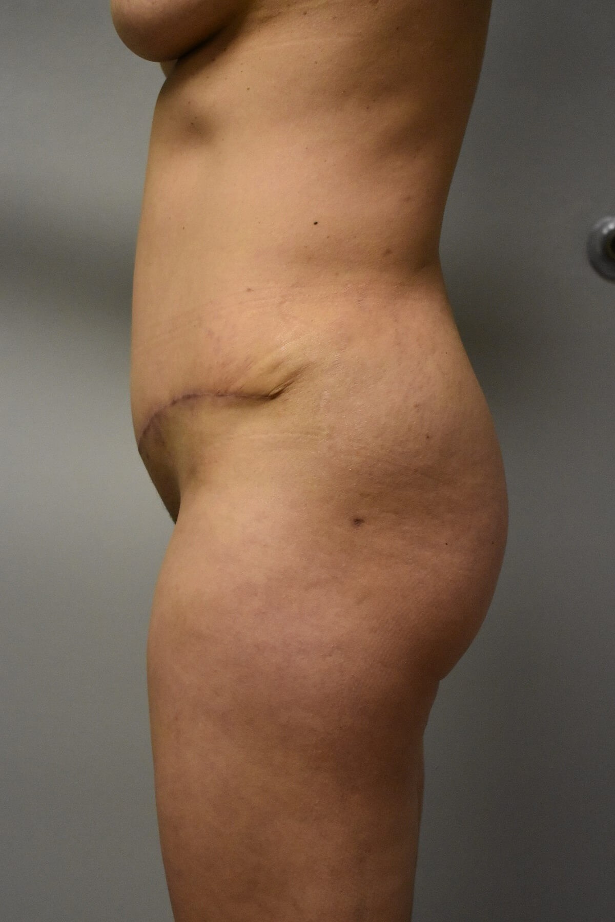 Side View After