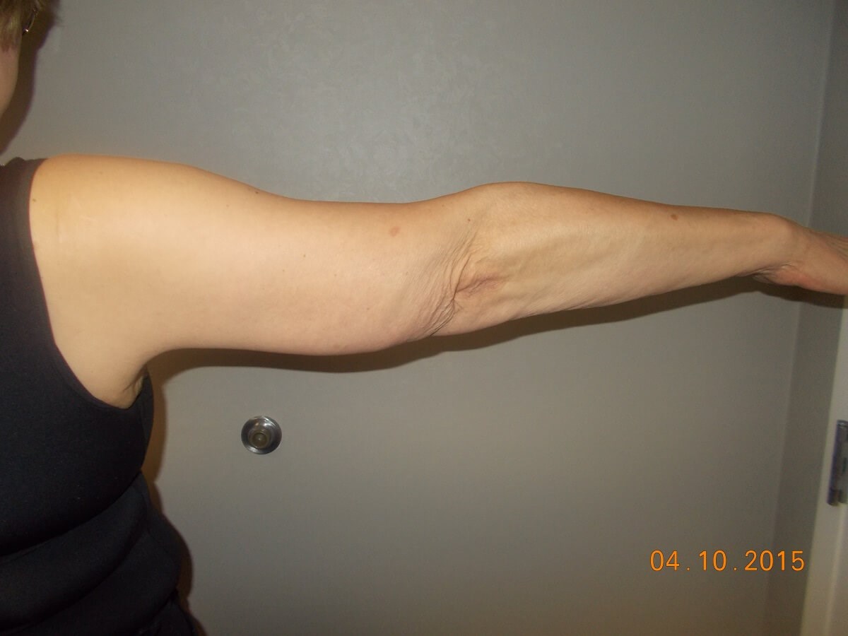 Back View Right Arm After