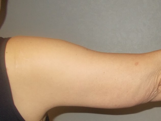 Back View Right Arm After
