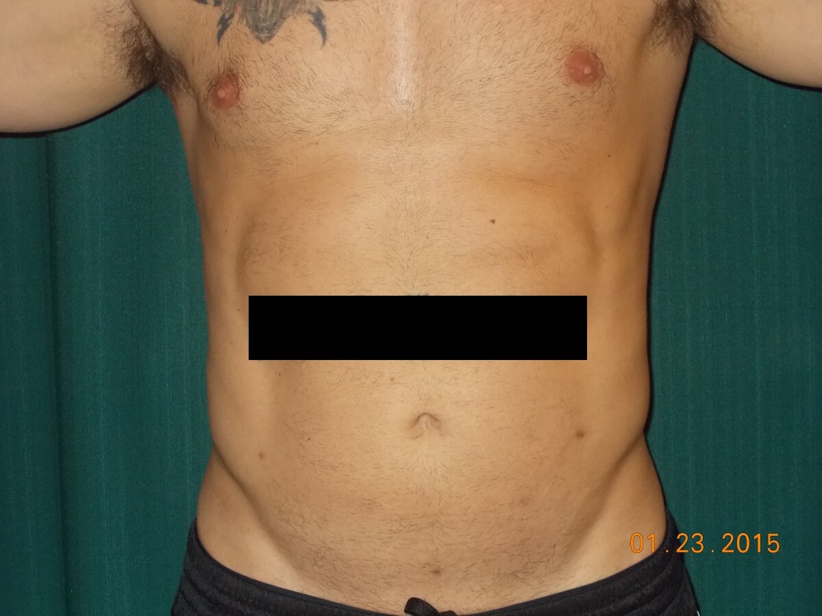 Front View After