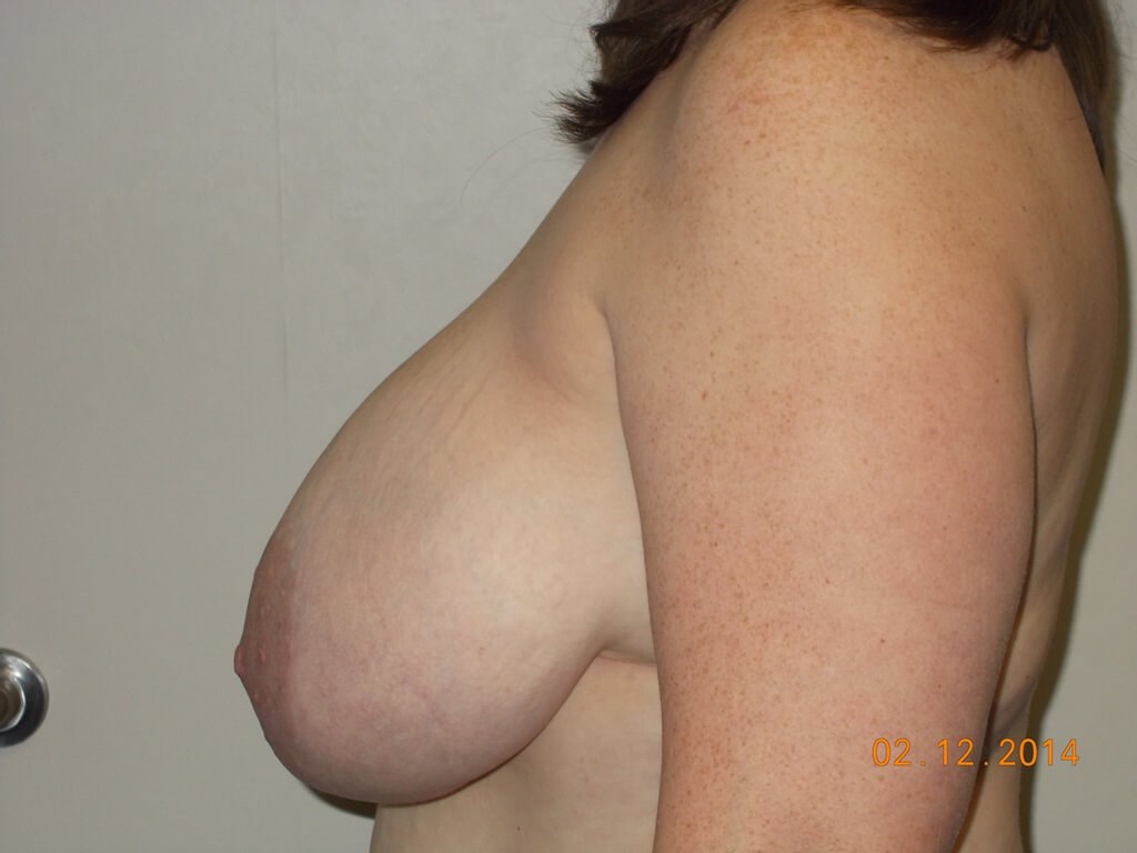 Side View Before