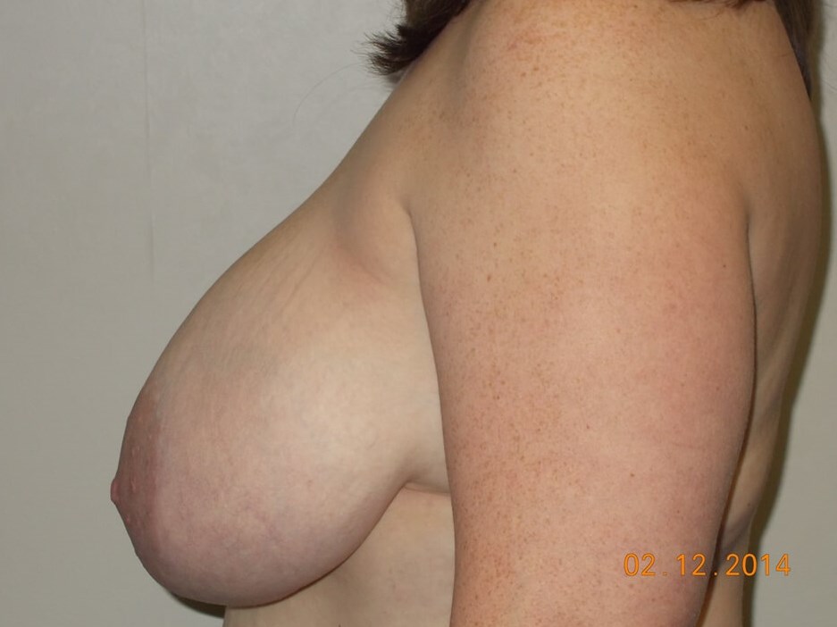 Side View Before