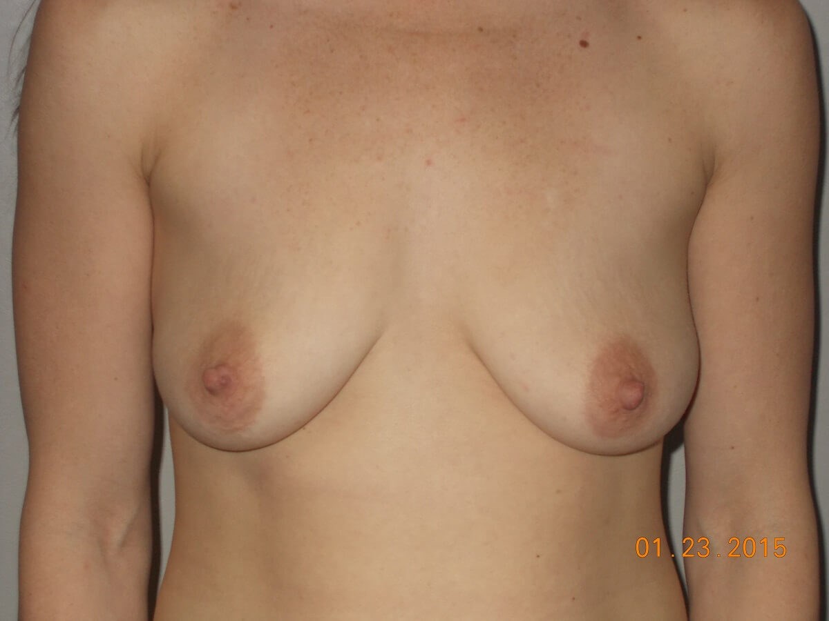Front View Breasts Before