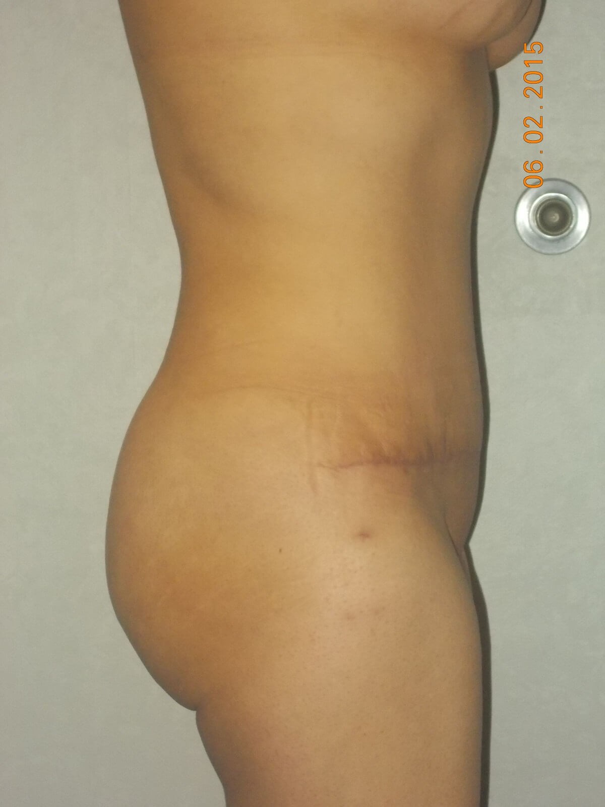 Side View After