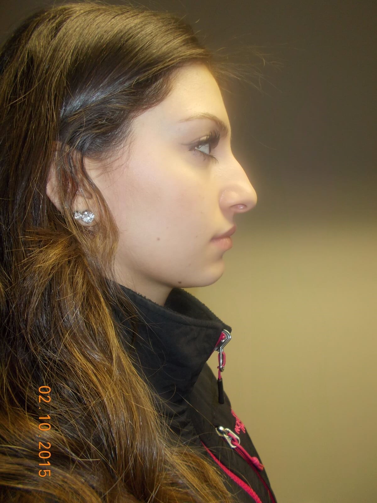 Side View Before