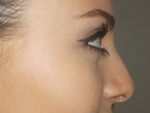 Side View After