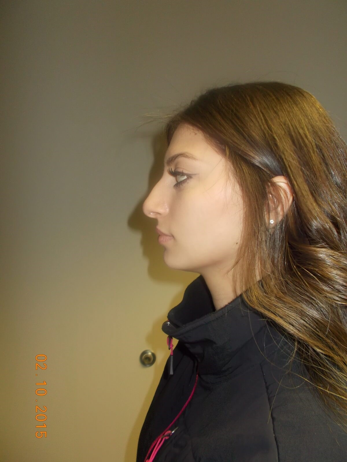 Side View Before