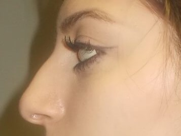 Side View Before