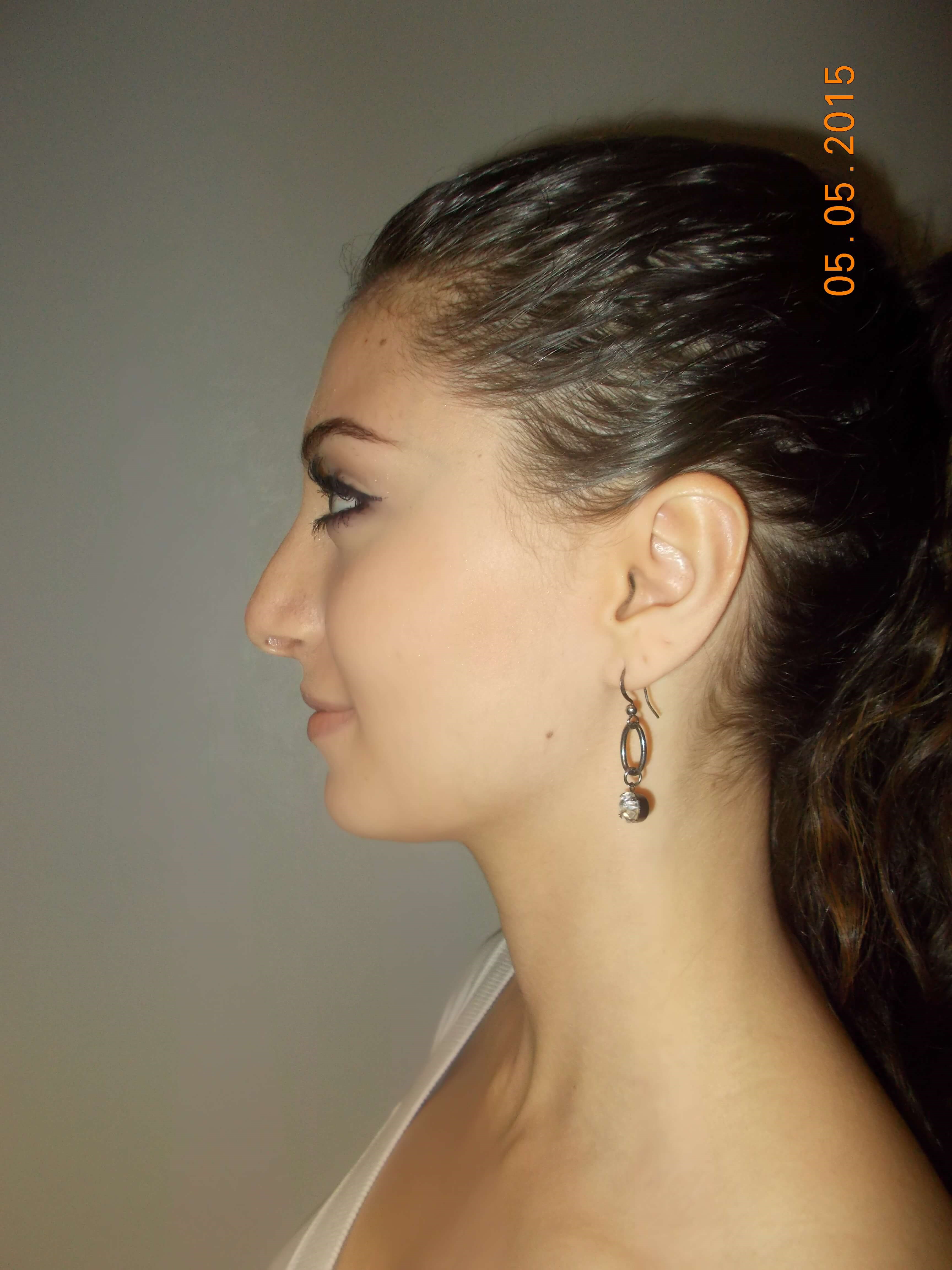 Side View After