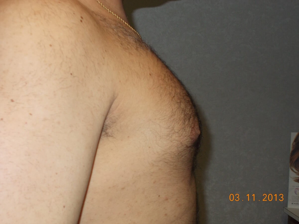 Side View Before