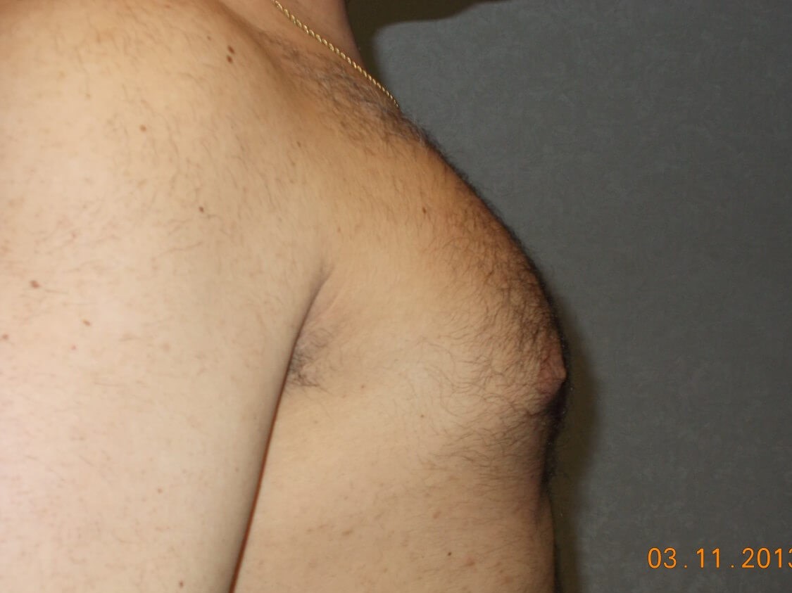 Side View Before