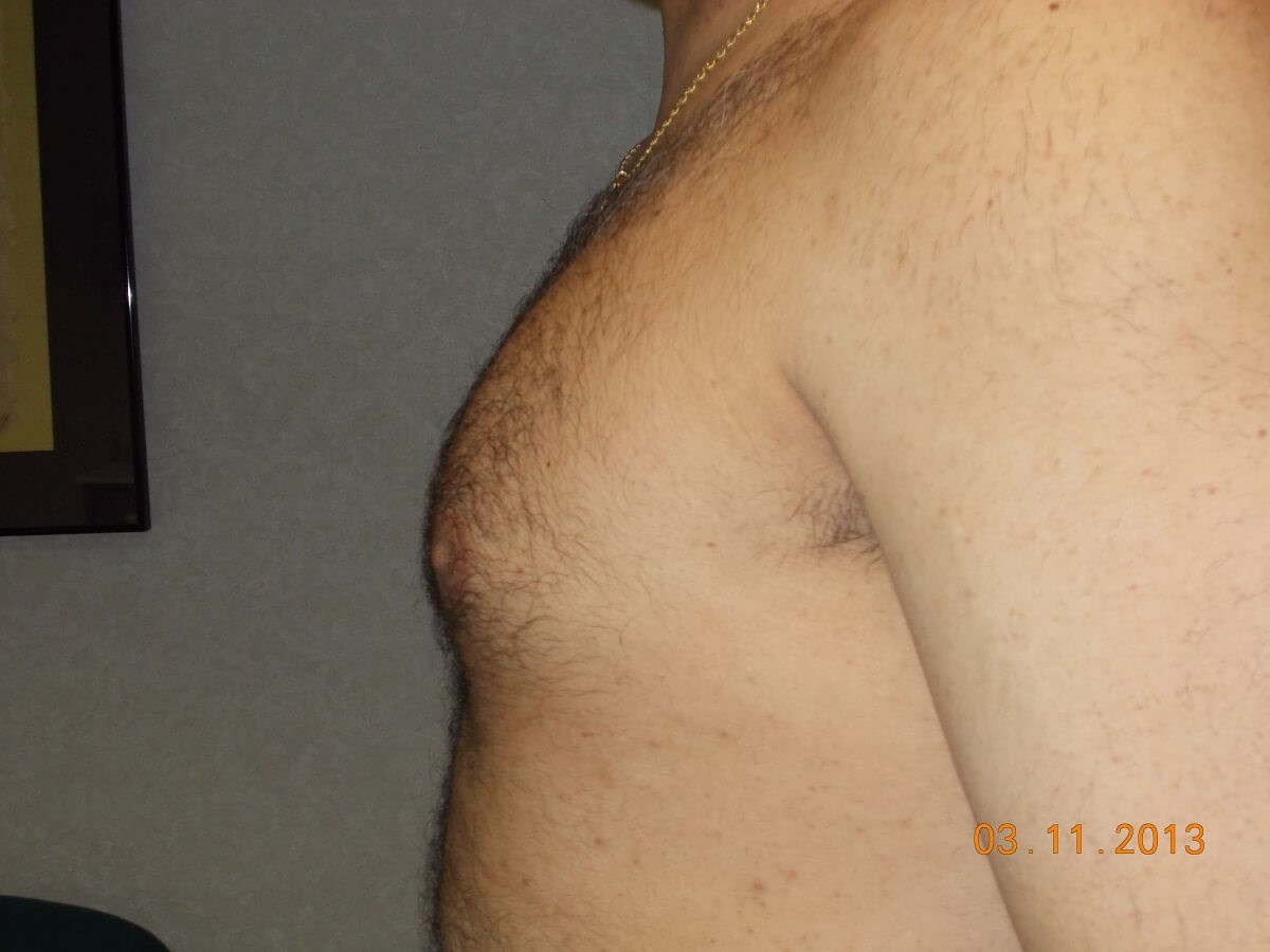 Side View Before