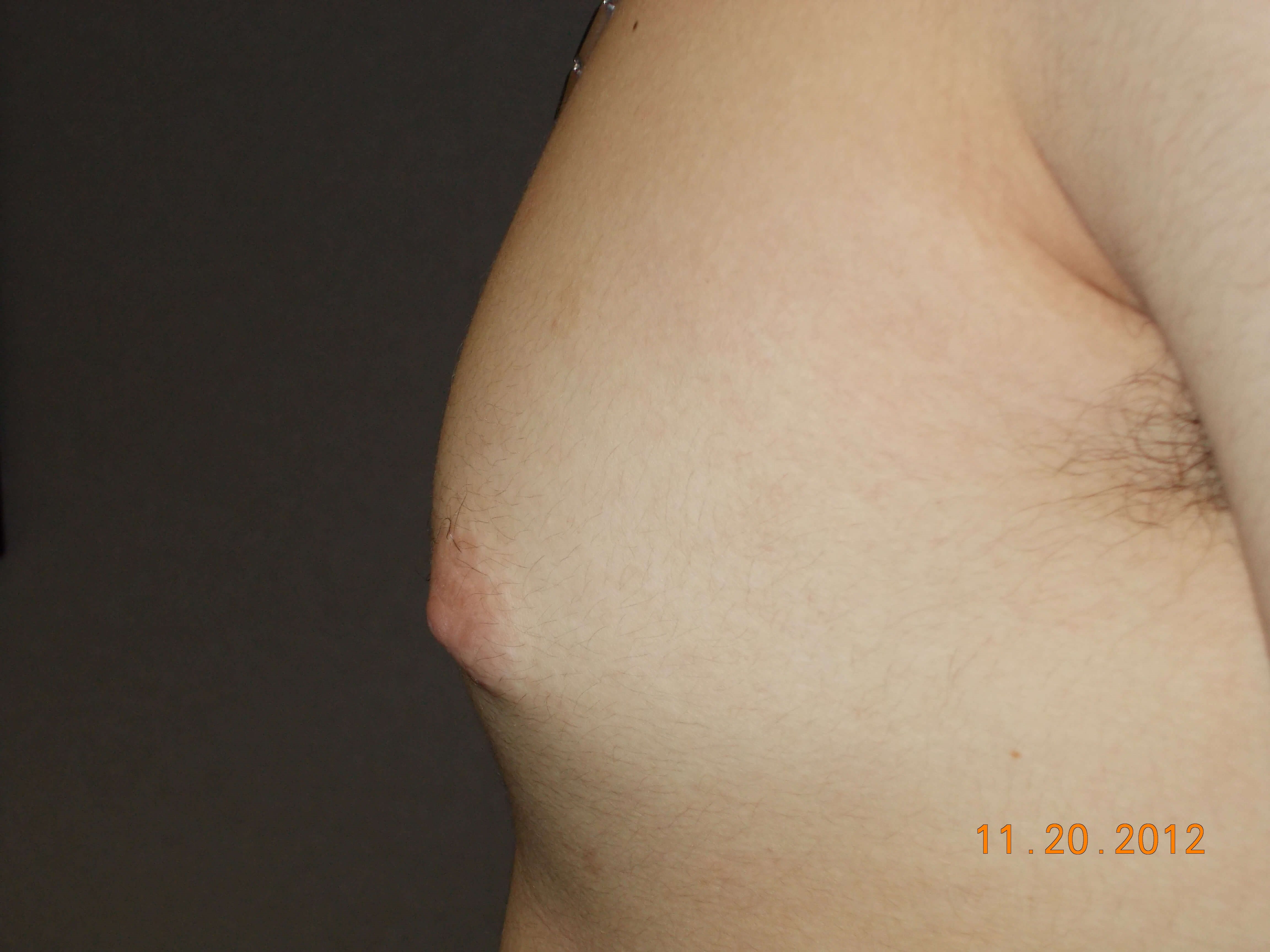 Side View Before