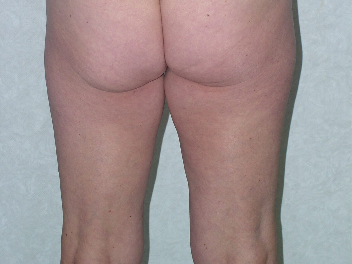 Back View Before
