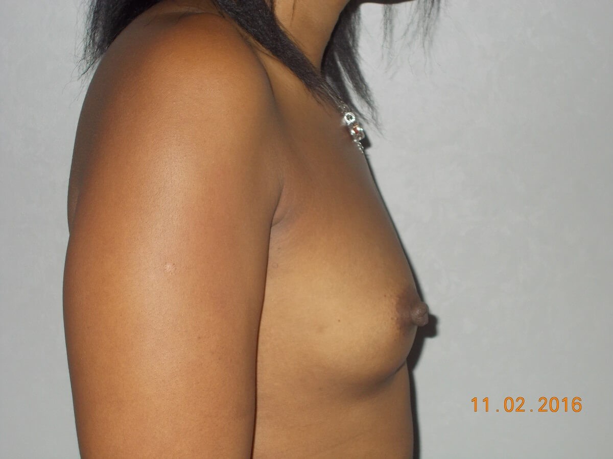 Breast Augmentation Before