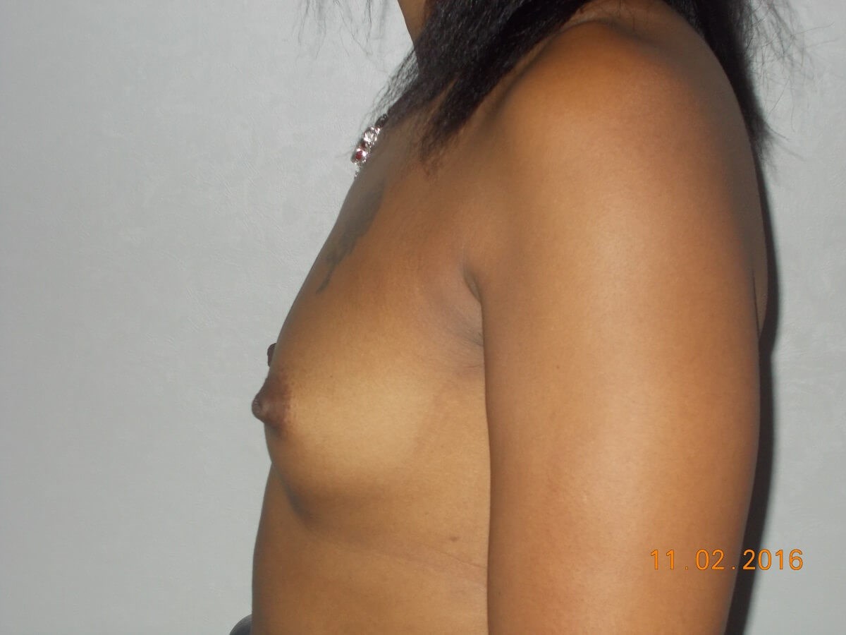 Breast Augmentation Before