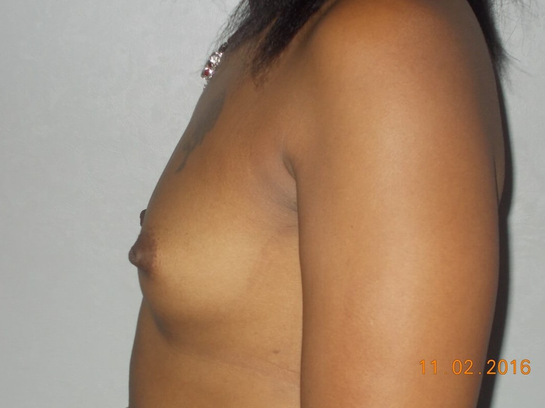 Breast Augmentation Before