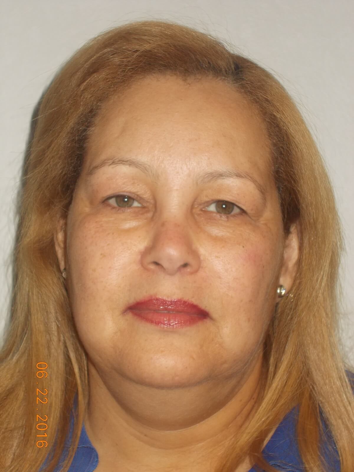 Bilateral Upper Blepharoplasty Before