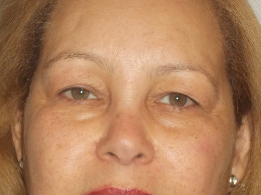 Bilateral Upper Blepharoplasty Before
