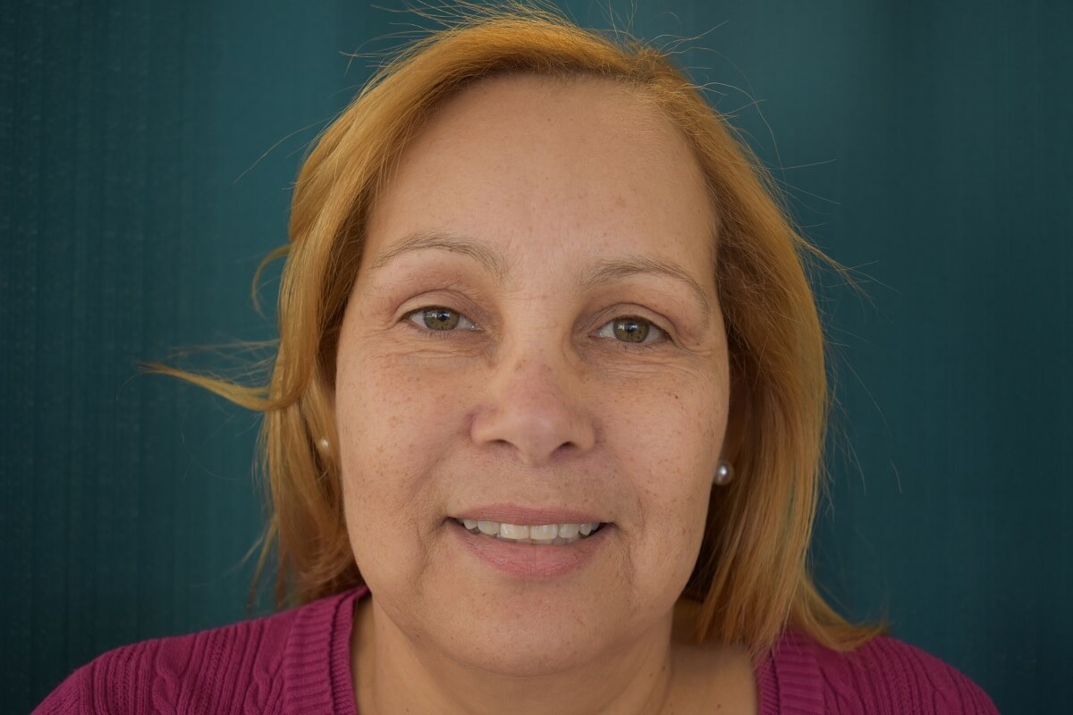Bilateral Upper Blepharoplasty After