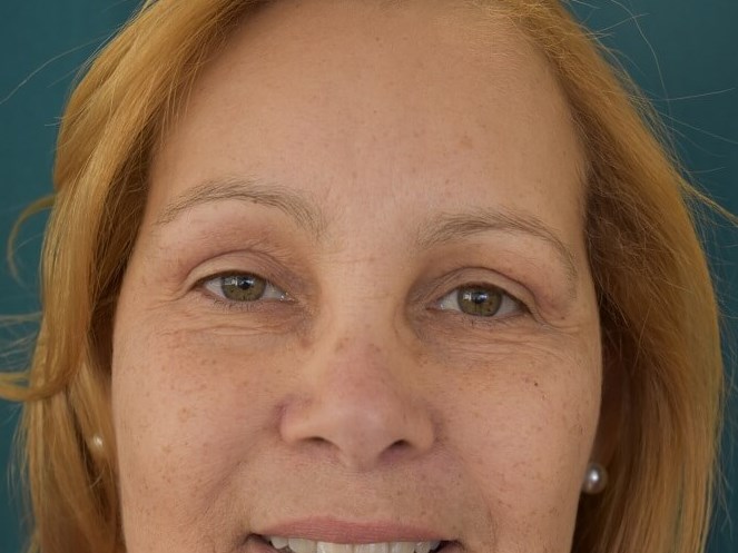 Bilateral Upper Blepharoplasty After