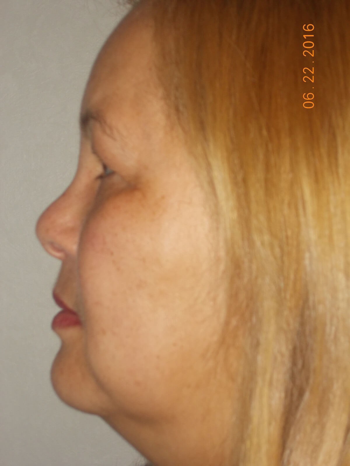 Bilateral Upper Blepharoplasty Before
