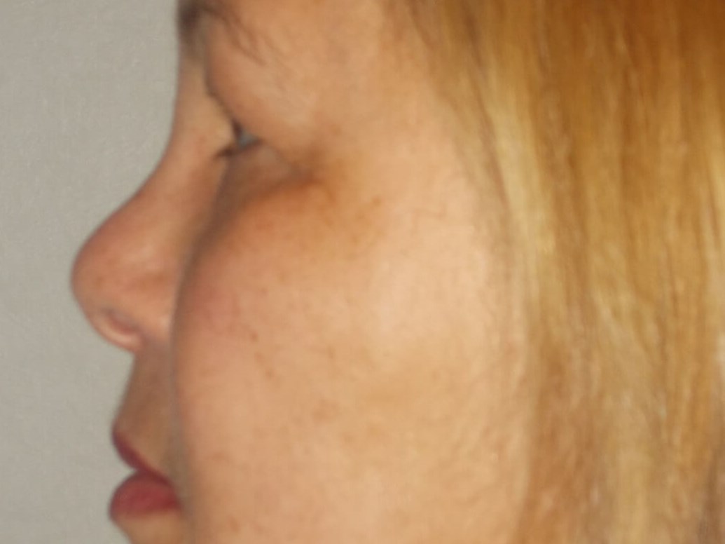 Bilateral Upper Blepharoplasty Before